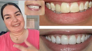 تبيض الأسنان في المنزل وعن تجربة وداعآ لرائحة الكريهة من أول إستعمال كلنا معا الإبتسامة الجميله