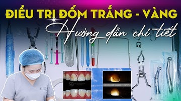 Điều Trị Đốm Trắng, Vàng Trên Răng Với Icon DMG – Hướng Dẫn Chi Tiết | Bác sĩ Trung Long Biên