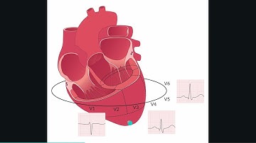 ECG R wave progression in a nutshell (including case discussion)