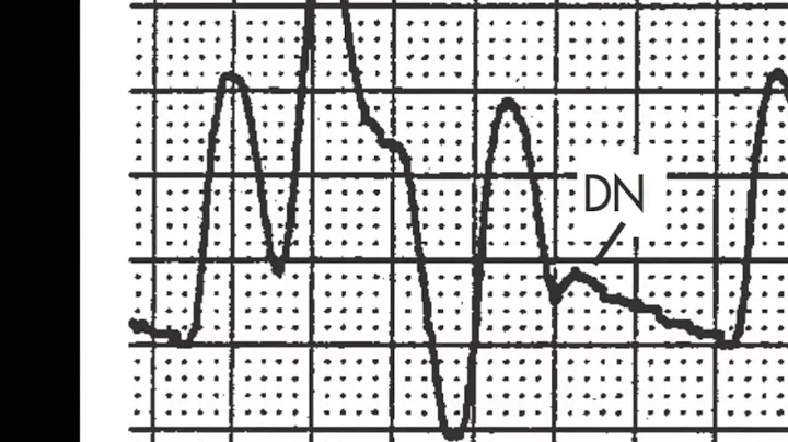 Timing and triggering of the Intra-aortic Balloon Pump (IABP)