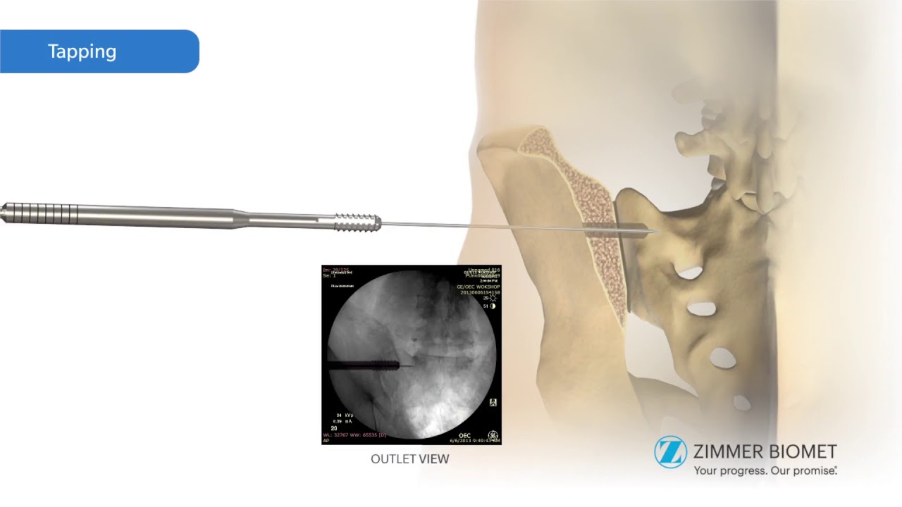 TriCOR Open Technique camera iphone 8 plus apk