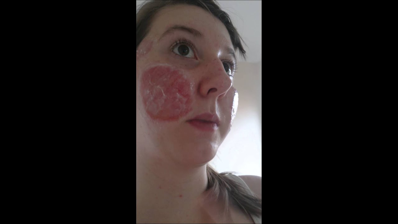 Day 2 of co2 laser treatment for pitted acne scars - YouTube