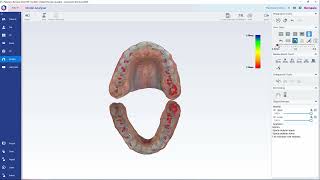 Как сканировать и анализировать в модуле Planmeca Romexis Model Analyser