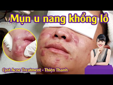 Video Điều trị mụn u nang siêu to tại Hiền Vân Spa | Trị mụn... - youtube