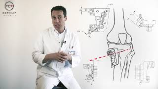 Dr. Sebastien Parratte M.d Phd Discusses Newclip Psi