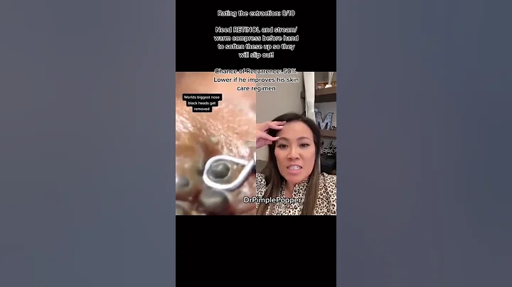 Rate This Extraction! Dr Pimple Popper Reviews Sat...