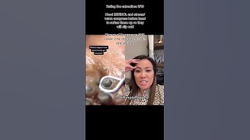 Rate This Extraction! Dr Pimple Popper Reviews Satisfying Extraction #shorts