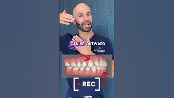 Adult crossbite fix with Invisalign. ￼