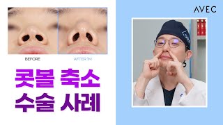 콧볼 축소ㅣ누구에겐 추천되지만 절대 하면 안 되는 경우는?