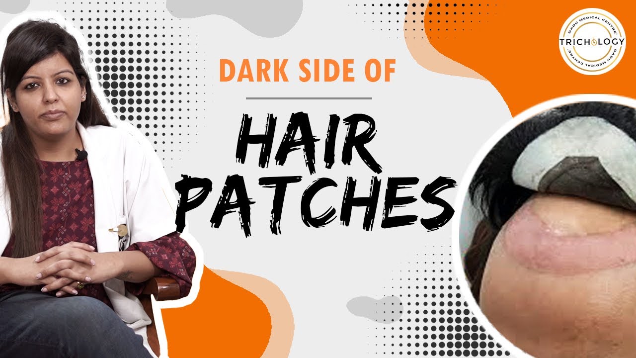 Dark side of hair patches ! | Dr. Nandini Dadu