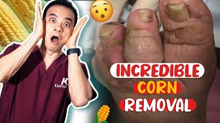 CUTE Corn Removal on Toe + HACK to Reduce Foot Swelling With Apple Cider Vinegar