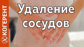 Удаление сосудов неодимовым лазером (Когерент)(, 2010-10-05T08:45:48.000Z)