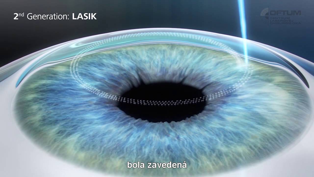 Laserová operácia očí metódou ReLEx SMILE: budúcnosť laserovej chirurgie oka