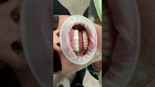 Minimal To No-Prep Veneers