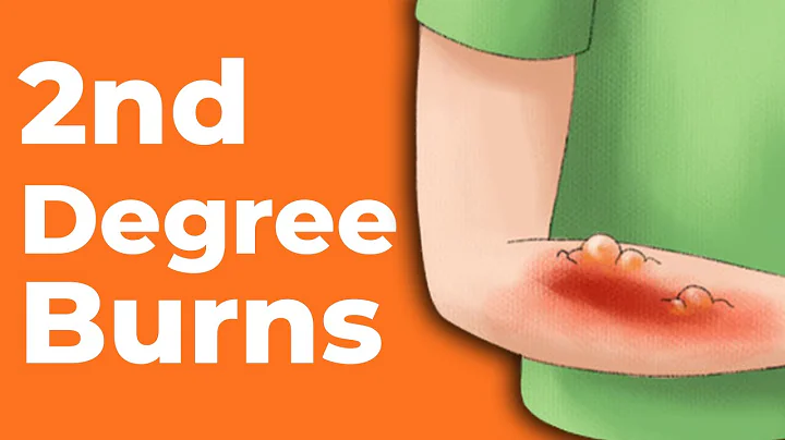 2nd Degree Burns: How to Treat Them | Wound Care OC