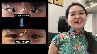 Squint Surgery Pembedahan Juling 斜视手术