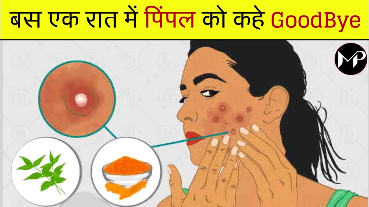 एक रात में पिंपल को कहे Good Bye Acne ko kaise khatam kare Pimple