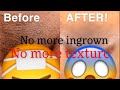 VTALK| HOW TO PREVENT INGROWN HAIRS AND TEXTURED SKIN