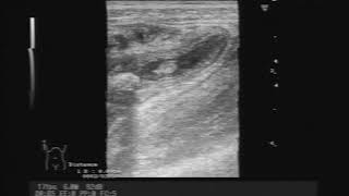 Acute Appendicitis With Ith M Inside