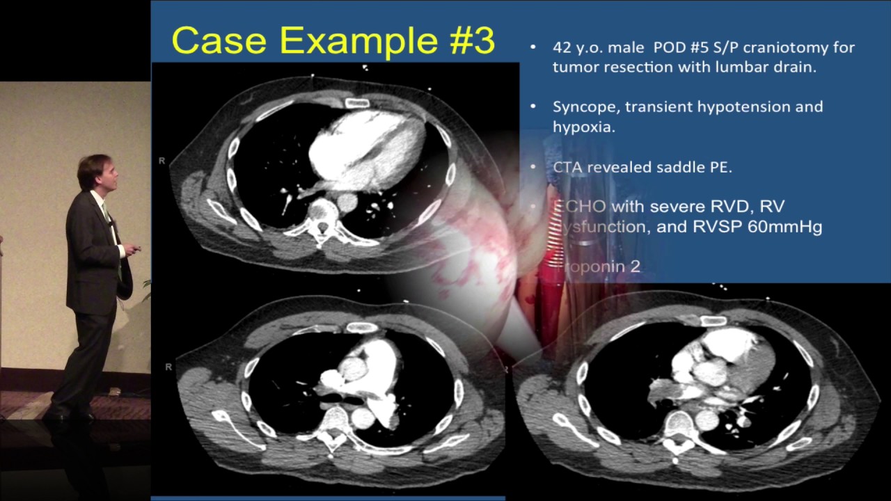 Acute and submassive PE: what are the PERTs? - Michael McDaniel comp