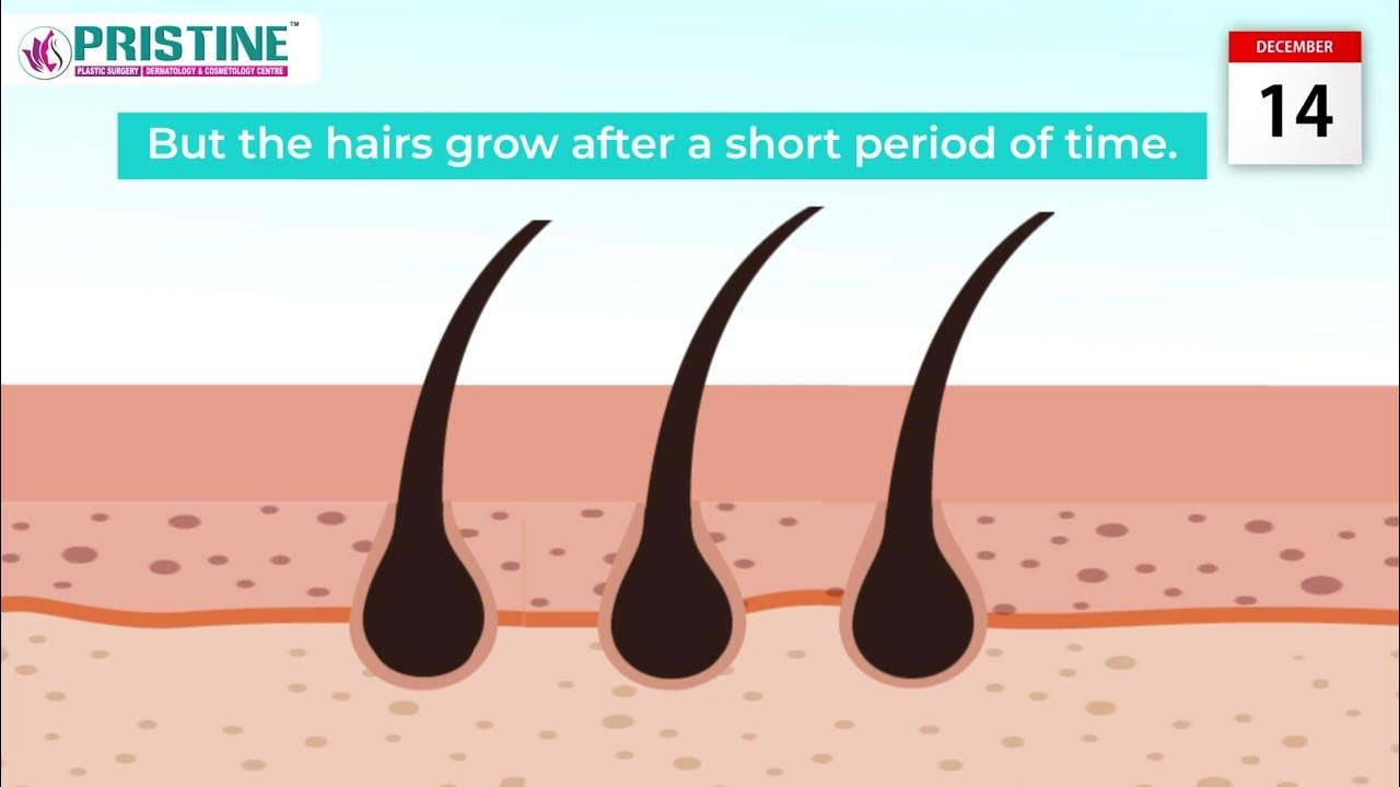 Shaving vs. Waxing vs. Laser Hair Removal Understanding the