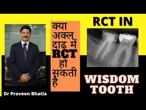 क्या अक्कल दाढ़ की RCT की जाती है -Can root canal is possible in wisdom ...