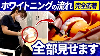 【完全密着Part2】ホワイトニング施術の裏側全部見せ！本当に痛くない？何分で終わる？