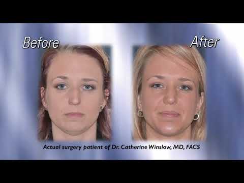 Video thumbnail: spot rhinoplasty — Winslow Facial Plastic Surgery