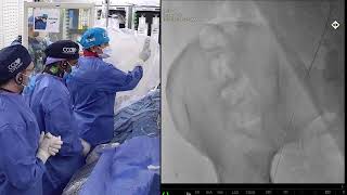 Information #11: Ultreon 3.0 OCT-Guided PCI of a Long-Calcified RCA Lesion News