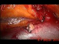 Laparoscopic right nephrectomy about half hour