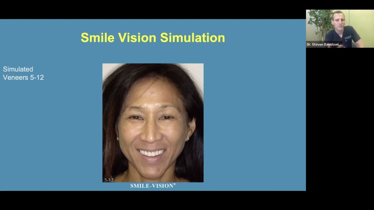 MOD MOUTH & SMILE VISION CASE STUDY - Veneers