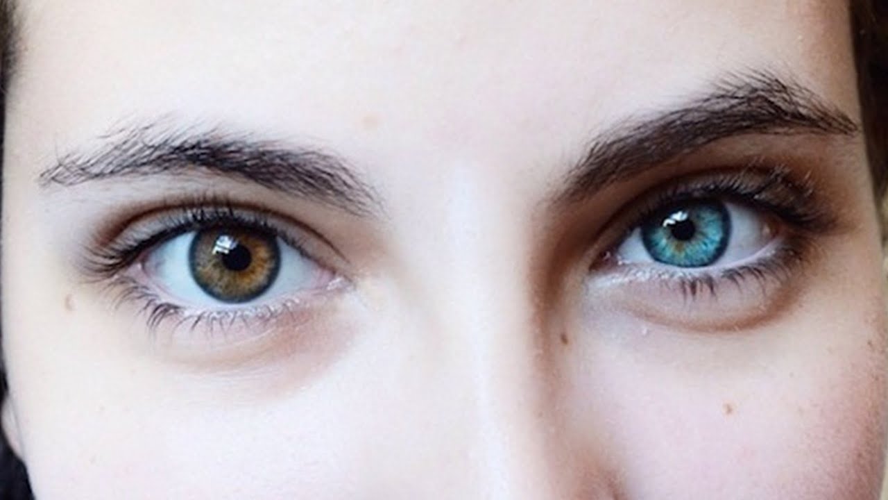 Как называется болезнь когда разный цвет глаз. Металлозная гетерохромия. Секторальная гетерохромия глаз. Гетерохромия зеленый и Карий. Поликория и гетерохромия.