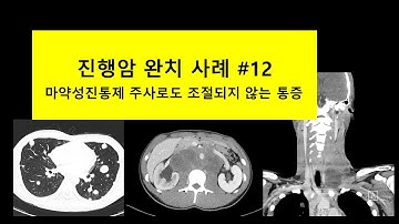 진행암 완치 사례 #12 (마약성진통제 주사로도 조절되지 않는 통증)