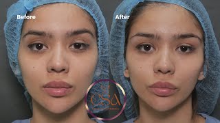 Nonsurgical treatment for dark circles and droopy or tired looking eyes