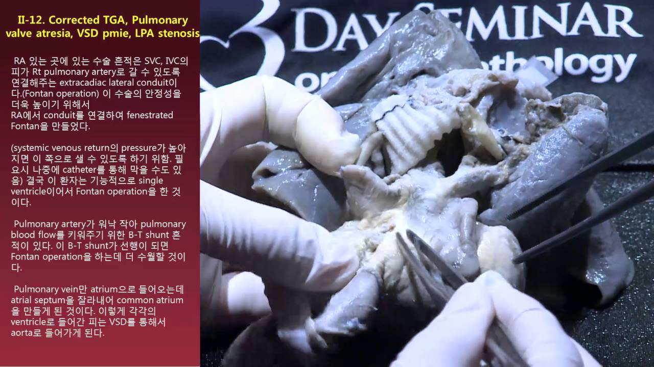 II. Corrected TGA-12. Pulmonary valve atresia