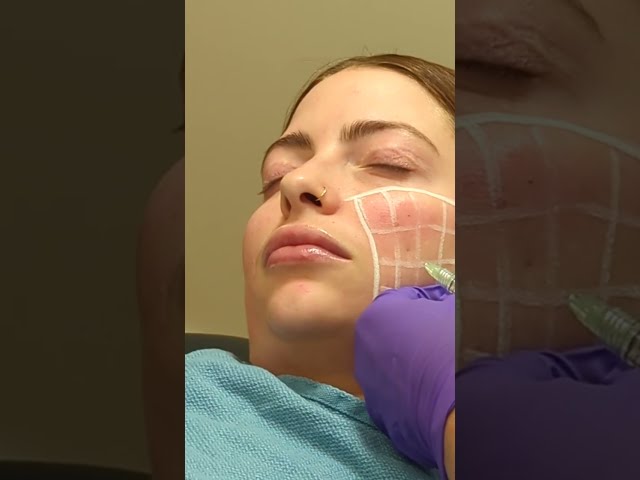 Skinvive Treatment