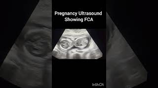 Pregnancy Ultrasound showing FETAL cardiac activity!fetal heart beat#ultrasoundmadeeasy86#baby screenshot 4