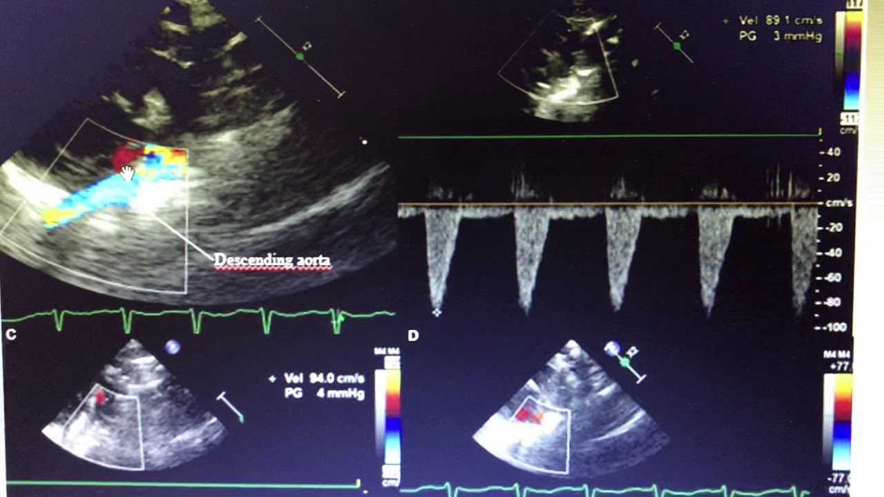 Descending aortic Doppler in PDA - YouTube