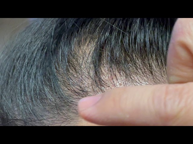 Dallas Asian Female Hair Transplant Close-Up