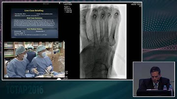 [Endovascular Symposium] Live Case Session II. Below the Knee or SFA Intervention