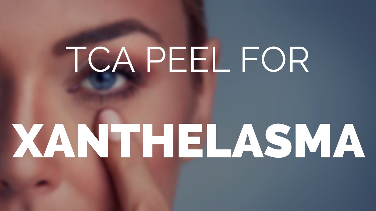 Tca peel for xanthelasma, is it the best treatment? YouTube