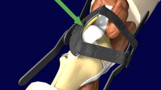 PTO (Patellar Tracking Orthosis) Knee Brace Directions and Application screenshot 2