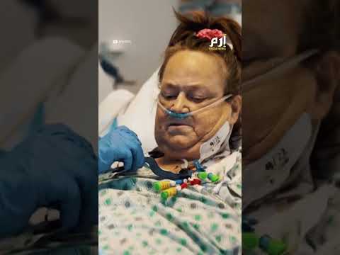كلية خنزير ت زال من جسم امرأة بعد 47 يوم ا من زرعها ما الذي حدث