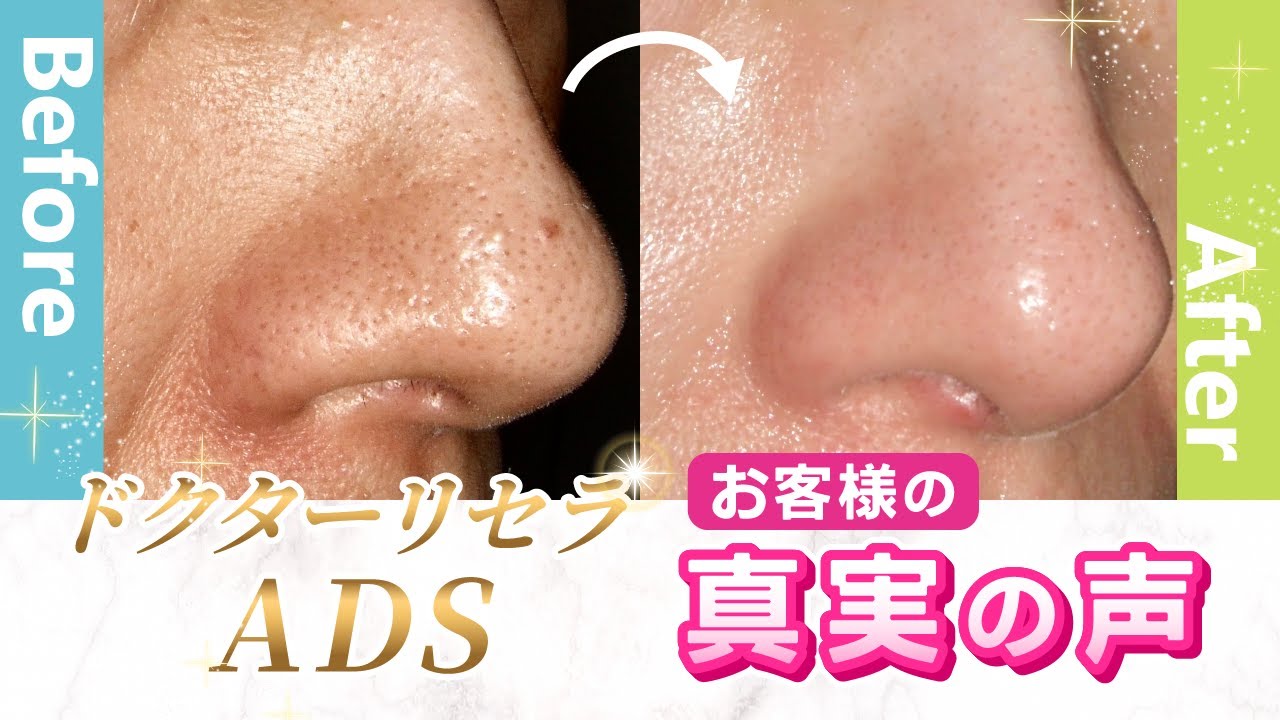 ドクターリセラADS「真実の声」 「毛穴・いちご鼻・シミ」 - YouTube
