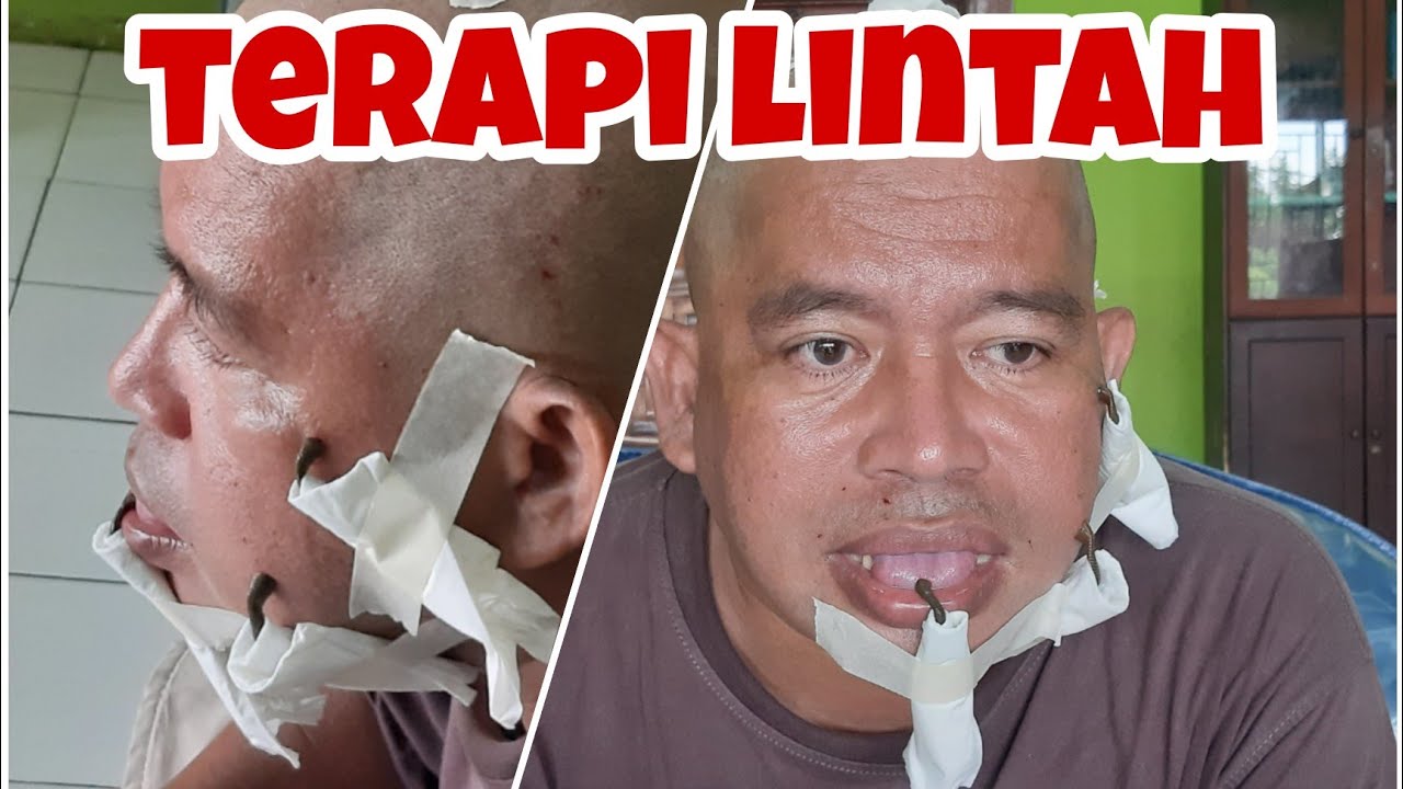 Terapi lintah untuk stroke
