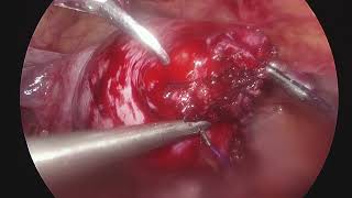 M 20032024115714 0U23308032099912 myomectomy part 3