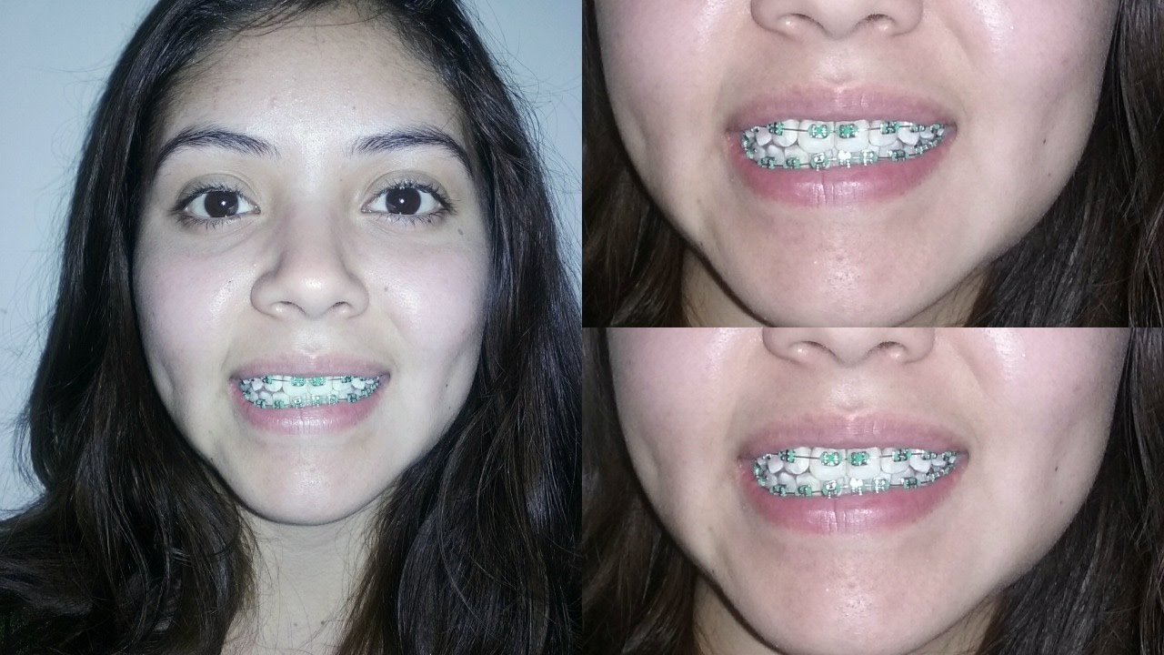 I GOT Green BRACES ! YouTube