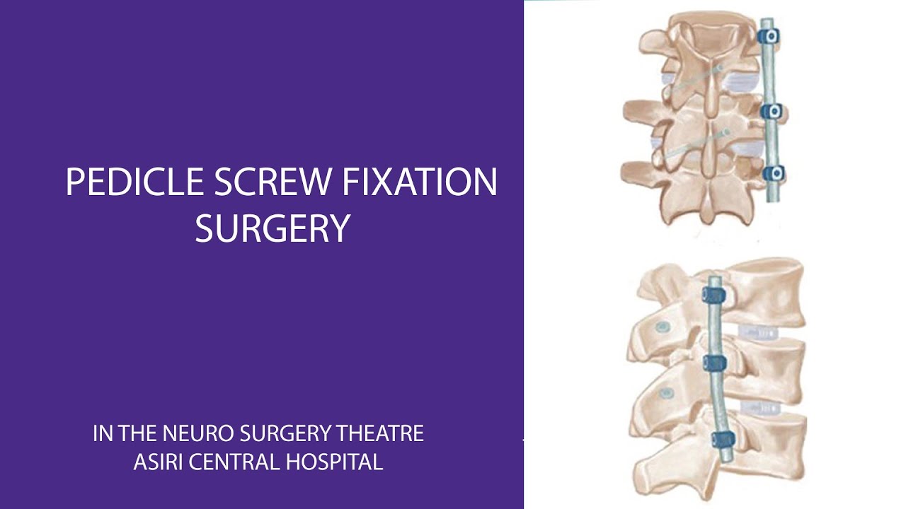 Pedicle screw fixation surgery YouTube