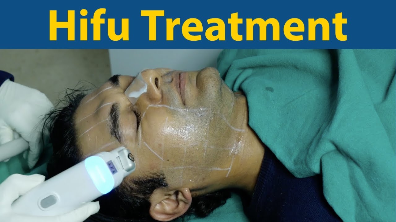 Hifu Face Lifting Treatment - Breaking the myths with Dr Jyoti Gupta | NON-Surgical Face Lift