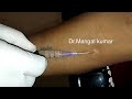 Intra dermal Injection#Sensitivity test: Anesthesia,Allergy,TB